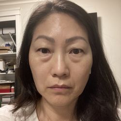 Wenjing Liu, MD - Before : heavy hooded eyelids and undereye bags