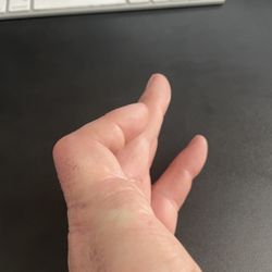 Tennessee Orthopaedic Clinics - How my finger looks on 3.25.2024.