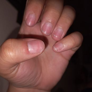 Creative Nails And Spa - Bubble on pinky in the corner and redness and sensitive nails on both hands - Nail Salons Near Me - Sacramento, California Creative Nails And Spa - Bubble on pinky in the corner and redness and sensitive nails on both hands - Nail Salons Near Me - Sacramento, California