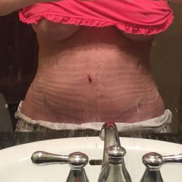 Shape is looking amazing. This is what Dr. Lacerna is known for. I am so excited I went to her!!!!! Getting very excited!!!