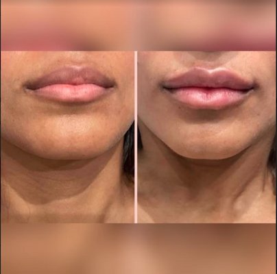 Hyaluronic Pen Filler - The Hyaluron Pen is a small handheld medical device that is used to administer hyaluronic acid fillers into the face. Hyaluronic Pen Filler - The Hyaluron Pen is a small handheld medical device that is used to administer hyaluronic acid fillers into the face.