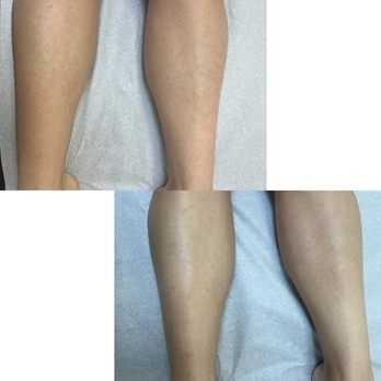 Beauty Electric - Half leg sugaring - Hair Removal Near Me Beauty Electric - Half leg sugaring - Hair Removal Near Me