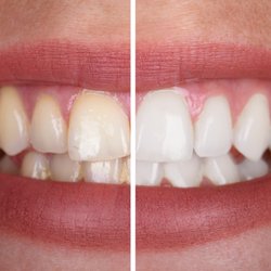 De Zavala Dental - Deep cleaning and Kor bleaching!