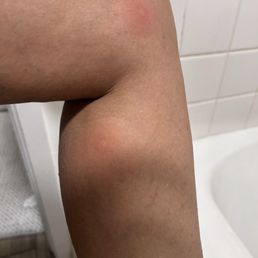 Bad mosquito bites