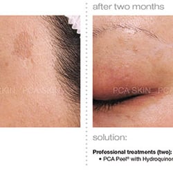 The Skin Boutique - After only 2 chemical peels and proper home care