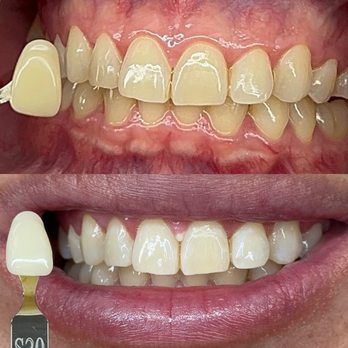 The Coco Blanc Teeth Whitening - Difference - Teeth Whitening Near Me - Whittier, California The Coco Blanc Teeth Whitening - Difference - Teeth Whitening Near Me - Whittier, California