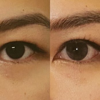 YokoMD - Upper blepharoplasty with little to no results - Medical Spas Near Me - Pasadena, California