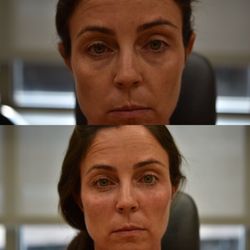 Daniel Straka , MD - Before and after lower eyelid (under eye) and cheek filler.