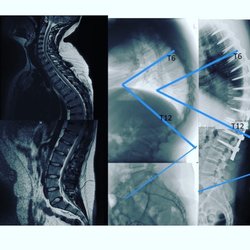 Midessa Neurosurgery and Complex Spine - Before and after surgery