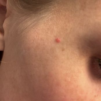 Metropolis Dermatology - Scarring done to my face - Dermatologists Near Me - Los Angeles, California