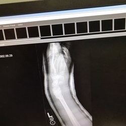 Christopher Metz, MD - broken arm