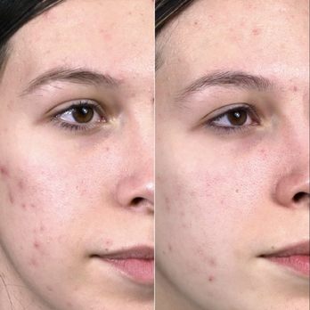Exotica Skin Care - Acne scars - Waxing Near Me - Henderson, Nevada Exotica Skin Care - Acne scars - Waxing Near Me - Henderson, Nevada