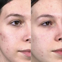 Exotica Skin Care - Acne scars