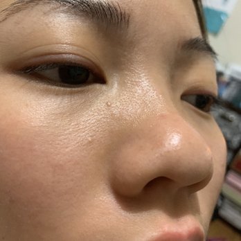 Luxe Lashes By Leanne - You could see 2 of the milium cysts in this photo. - Eyelash Service Near Me - Honolulu, Hawaii Luxe Lashes By Leanne - You could see 2 of the milium cysts in this photo. - Eyelash Service Near Me - Honolulu, Hawaii