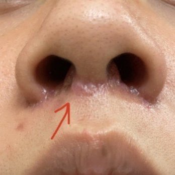 Asia Pacific Aesthetics - botched scar - Cosmetic Surgeons Near Me - Honolulu, Hawaii