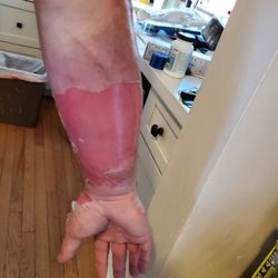 Fairview Pharmacy & Homecare Supply - This is one of the burns that they has me put the sandpaper gauze on!