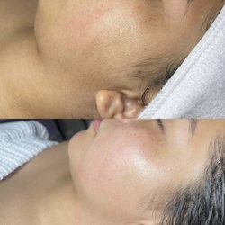 Sweet Soul Beauty Bar - Before and after of a Dermaplaning Facial