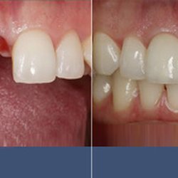 Sugar Creek Smile Dentistry - Before & After Dental Implant