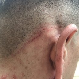 They cut my head open with the straight edge razor by cutting vertically like an idiot They cut my head open with the straight edge razor by cutting vertically like an idiot