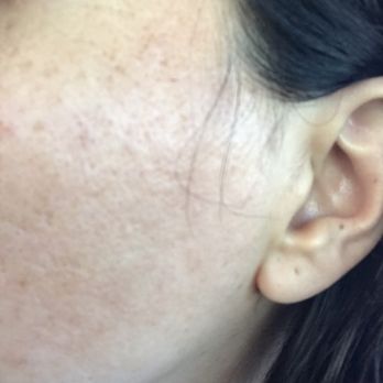 Diamond Nails - Redness of skin three days after waxing - Nail Salons Near Me - Downey, California