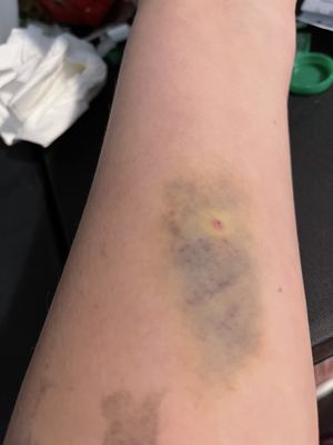 Photo of Regional Medical Center - San Jose, CA, US. This is how bad they left my arms once I went home .. took over 2 weeks to go away!!!