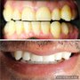 Teeth Whitening Lounge
