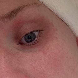 Six Fishes Healing Arts - The worst my rash was, night before first session (right eye).
