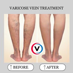 Vital Vein And Vascular - Placentia - Varicose Vein Treatment
(Before and After)