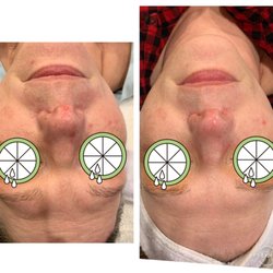 Vitality Health & Wellness - IPL photofacial