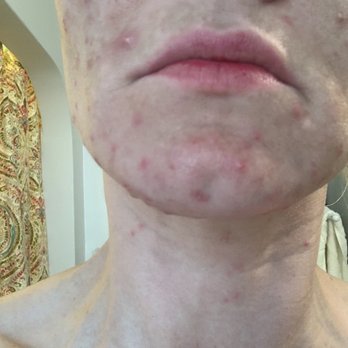 La Jolla Acne Specialists - This is almost 2 months with Christina. My family and friends were in disbelief and it killed my self esteem.. sucked big time. - Acne Treatment Near Me - San Diego, California La Jolla Acne Specialists - This is almost 2 months with Christina. My family and friends were in disbelief and it killed my self esteem.. sucked big time. - Acne Treatment Near Me - San Diego, California