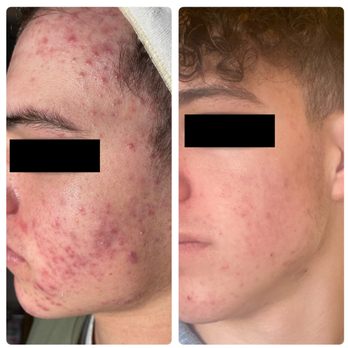 Beautiful Skin Denver - Teen Acne Before and After Acne Boot Camp - Laser Hair Removal Near Me - Denver, Colorado Beautiful Skin Denver - Teen Acne Before and After Acne Boot Camp - Laser Hair Removal Near Me - Denver, Colorado
