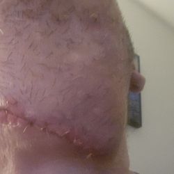 University of Pittsburgh School of Dental Medicine - Result of tooth extraction