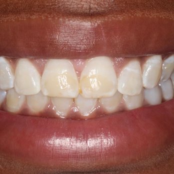 Pixel Dental - Esthetic Crown lengthening - Cosmetic Dentists Near Me - Mckinney, Texas Pixel Dental - Esthetic Crown lengthening - Cosmetic Dentists Near Me - Mckinney, Texas