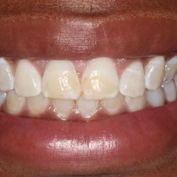 Pixel Dental - Esthetic Crown lengthening