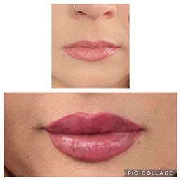 Before & after my lip injections by Paige at Evolve Med Spa. She's the best!!!!