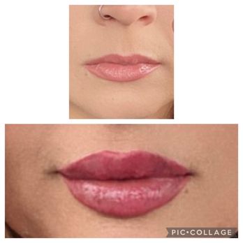 Evolve Med Spa - Jersey City - Before & after my lip injections by Paige at Evolve Med Spa. She's the best!!!! - Medical Spas Near Me - Jersey City, New Jersey