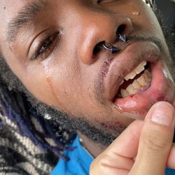 7-Eleven - Busted lip, blood, facial scratching/bruising