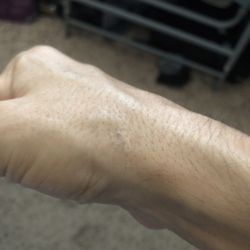 St Pete Tattoo Removal - Used to be a black nickel-sized tattoo here, now just a tiny little spot which I don't even notice. Scar was already there btw