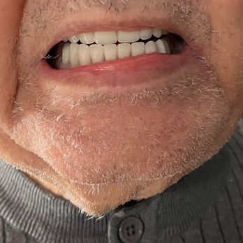 Perfect Smile Dental - My father's new set of dentures. - Cosmetic Dentists Near Me - Tijuana, BCN Perfect Smile Dental - My father's new set of dentures. - Cosmetic Dentists Near Me - Tijuana, BCN