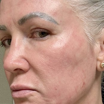 David Kaufman, MD - The Natural Result - 1 month - Plastic Surgeons Near Me - Folsom, California David Kaufman, MD - The Natural Result - 1 month - Plastic Surgeons Near Me - Folsom, California