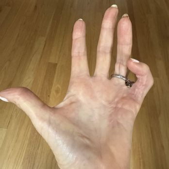 W Scott Green, MD - Pinky finger 8 months after surgery - Sports Medicine Near Me - San Francisco, California W Scott Green, MD - Pinky finger 8 months after surgery - Sports Medicine Near Me - San Francisco, California