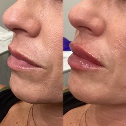 OrangeTwist - Westlake Village - BEFORE+AFTER: 1 syringe of Restylane Kysse! Injections by our amazing RN Sarah!