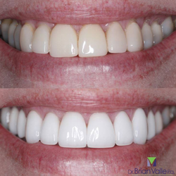 Brian D. Valle, P.A - We love the results! Look what new Porcelain veneers did for this beautiful smile.