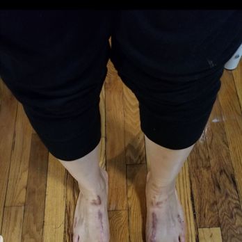 Mario Voloshin DPM, FACFAS - After surgery - Sports Medicine Near Me - Brooklyn, New York Mario Voloshin DPM, FACFAS - After surgery - Sports Medicine Near Me - Brooklyn, New York