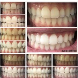 Organic Teeth Whitening System - effective without the pain and sensitivity like other whitening products.