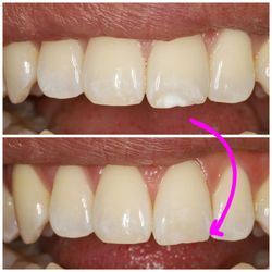 La Jolla Dental Studio - No drilling done here. Microabrasion and resin infiltration with Icon to remove white spot.