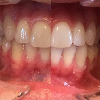 Bruce D Laurie, DMD - Zoom- whitening - Cosmetic Dentists Near Me - Ramona, California Bruce D Laurie, DMD - Zoom- whitening - Cosmetic Dentists Near Me - Ramona, California
