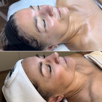 Living Water Aesthetics - Holiday Glow-up! Oil-plane, Biorepeel, & DMK Enzyme Therapy. - Skin Care Near Me - Bellevue, Washington