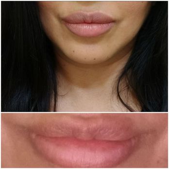 Beverly Hills Beauty - Before and after - Medical Spas Near Me - Beverly Hills, California