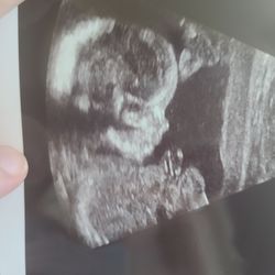 Hotchkiss ObGyn - 20 weeks! Perfect baby boy.